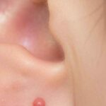 スピリチュアルでは耳は「受信機」：ニキビが出るときの共通テーマ