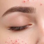 目の周りのニキビのスピリチュアルメッセージ